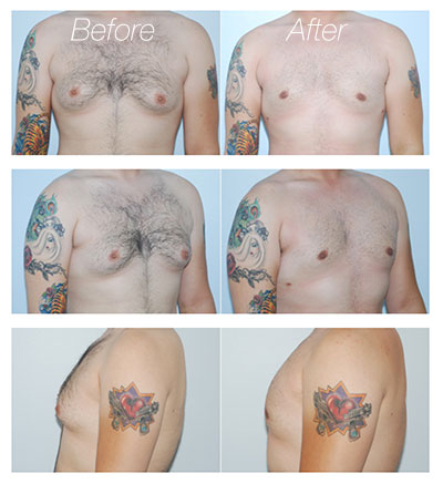 gynecomastia surgery los angeles